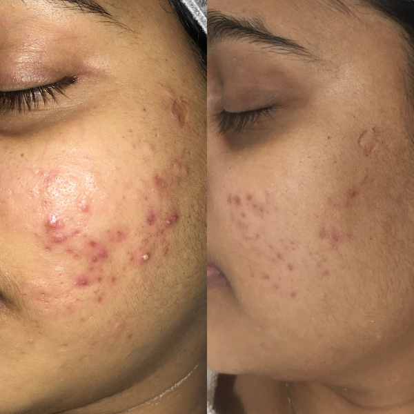 Best pimples treatment in vizag