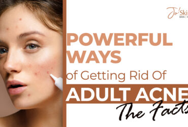 Adult Acne- Effective Ways Of Getting Rid of Adult Acne | Jo Skin Revive