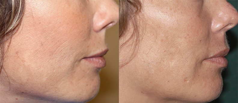 Laser hair removal treatments in vizag