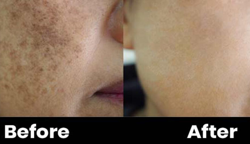 Pigmentation treatment 