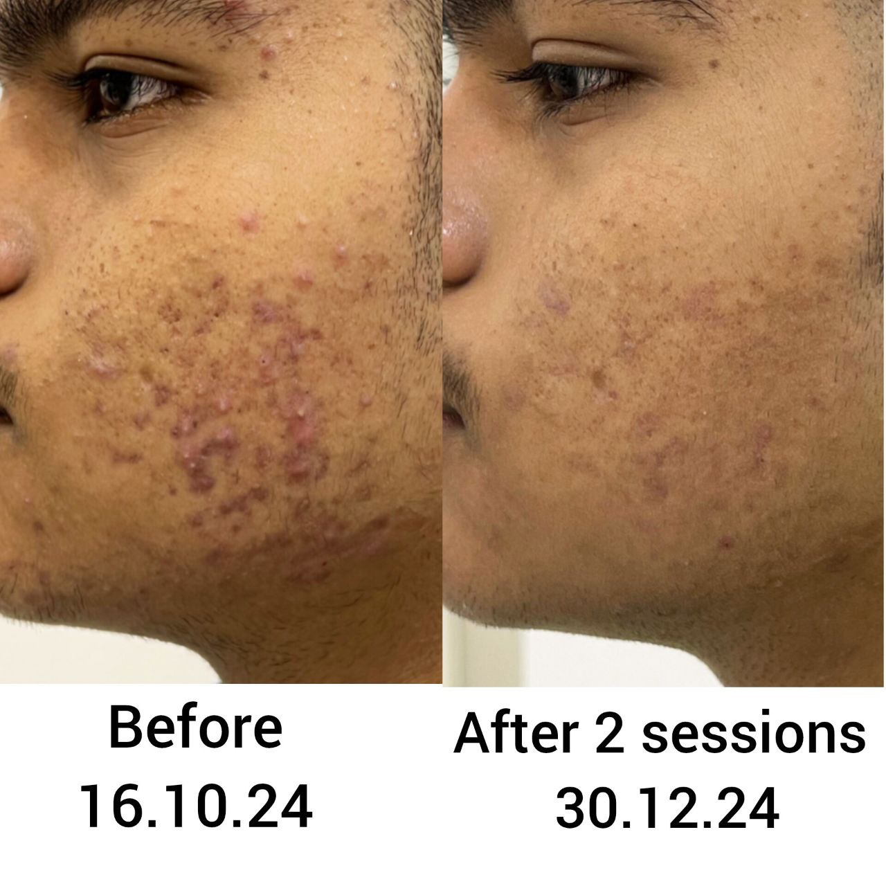 Best pimples treatment in vizag