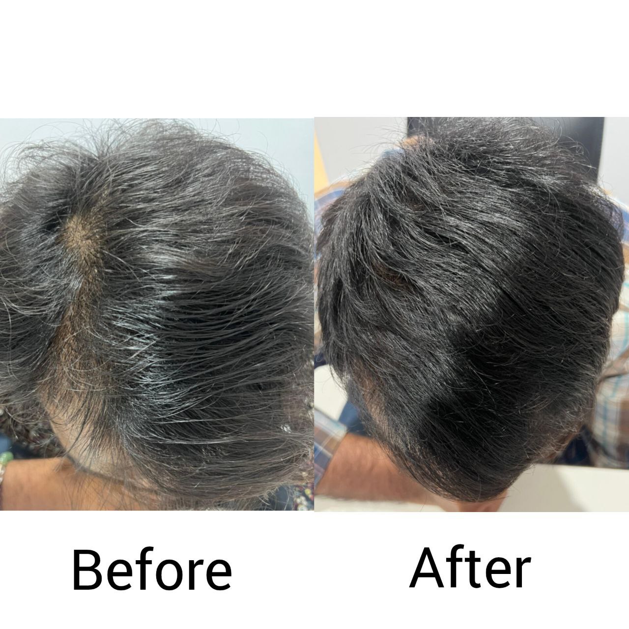 Best pimples treatment in vizag